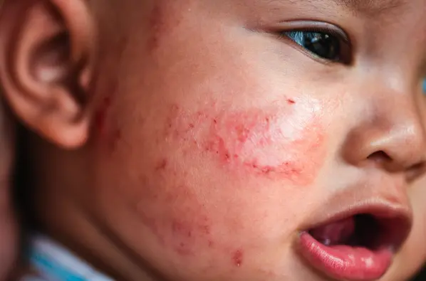 un enfant en crise d'allergie